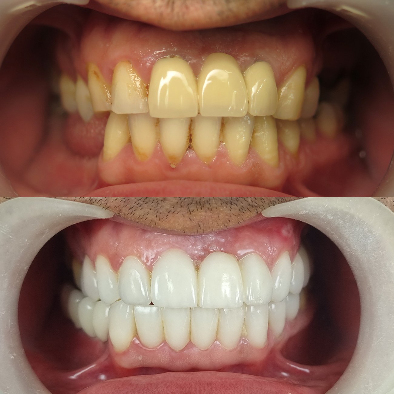 Cas 85 DM avant